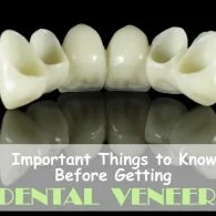 Important Things to Know Before Getting Dental Veneers