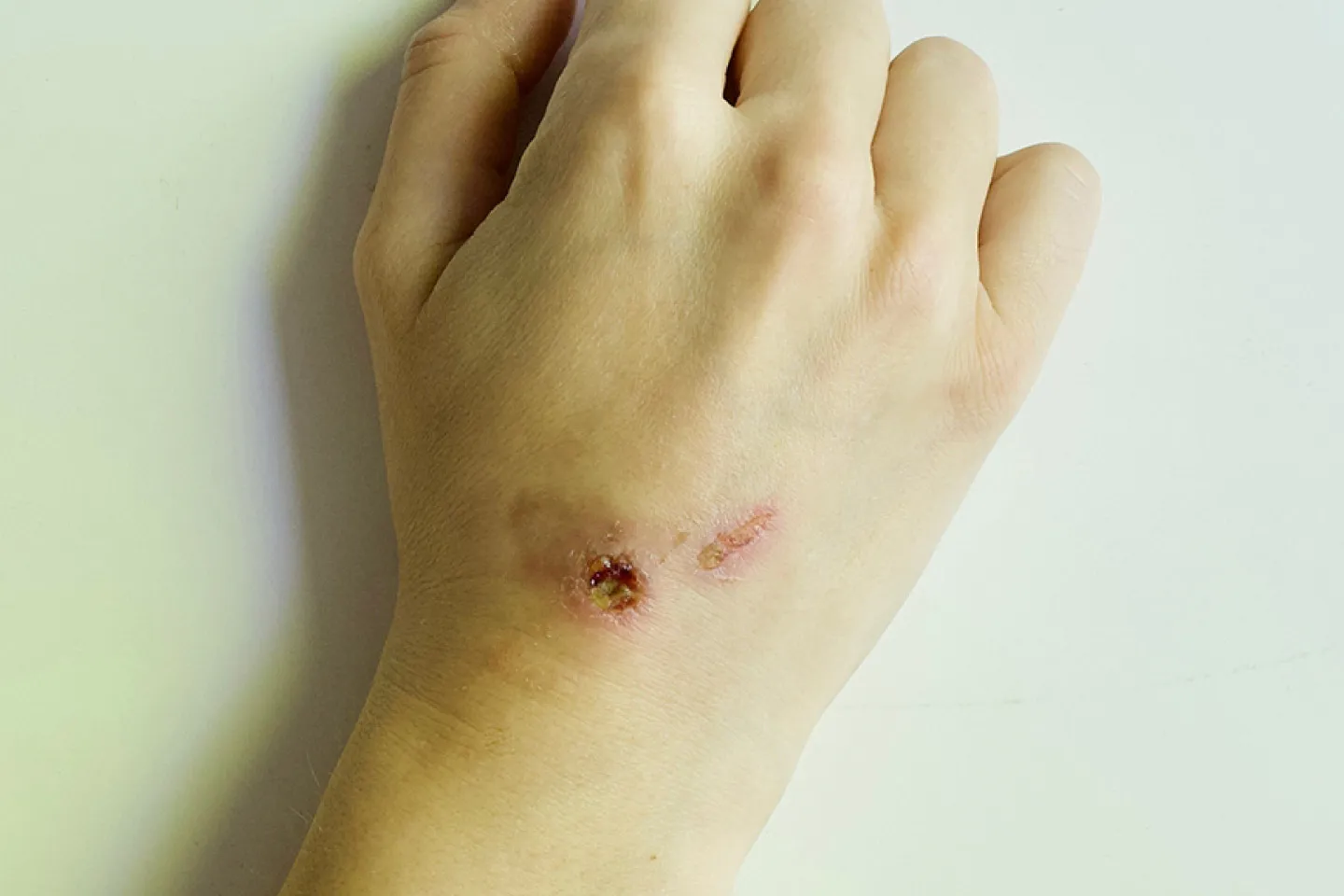Squamous Cell Carcinoma Treatment in Cleveland