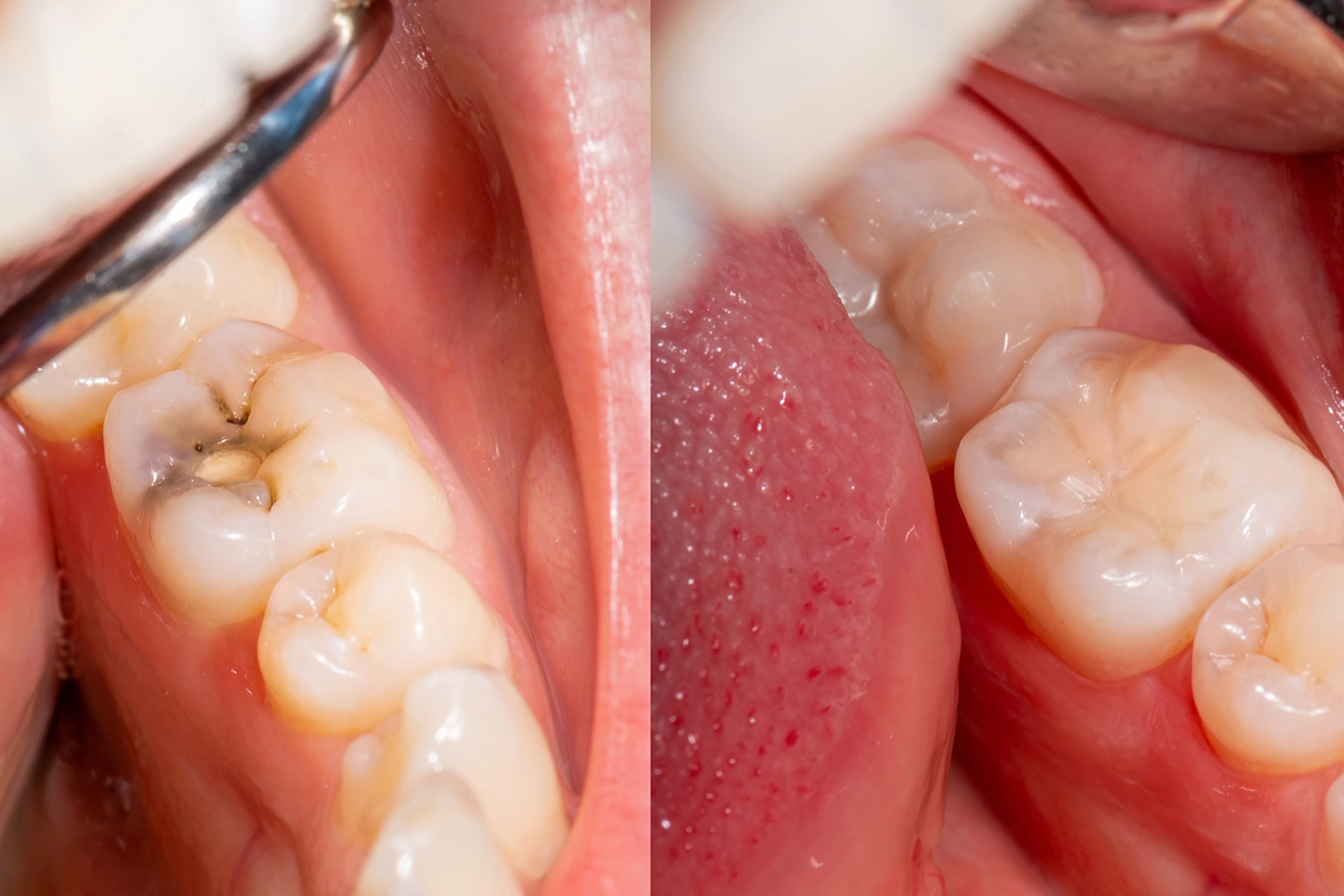 Types of Tooth Fillings: When Are Each Recommended?