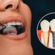 All On 4 Dental Implants Price in UK