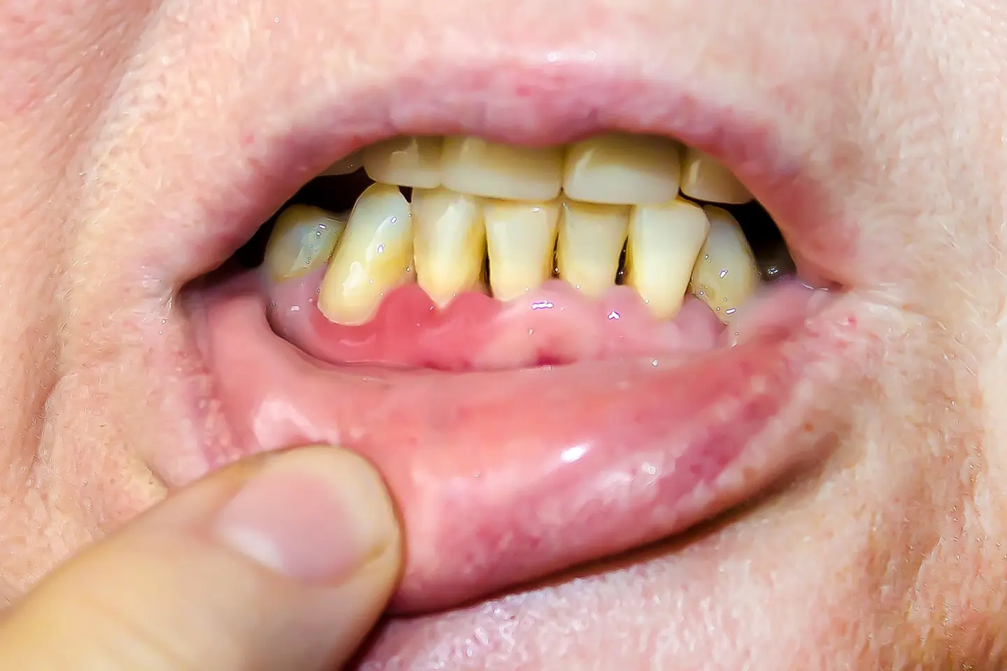 Periodontics - Rockville Family Dental