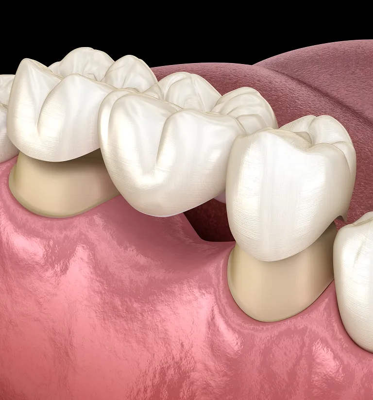 Single Tooth Implant