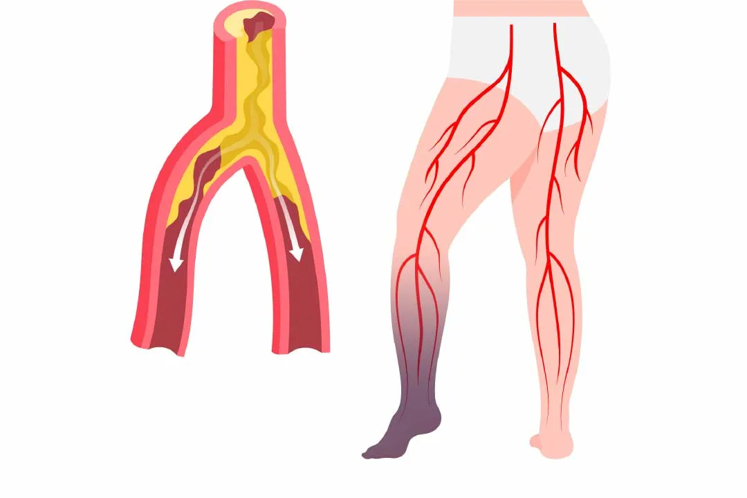 Peripheral Artery Disease (PAD) Surgery