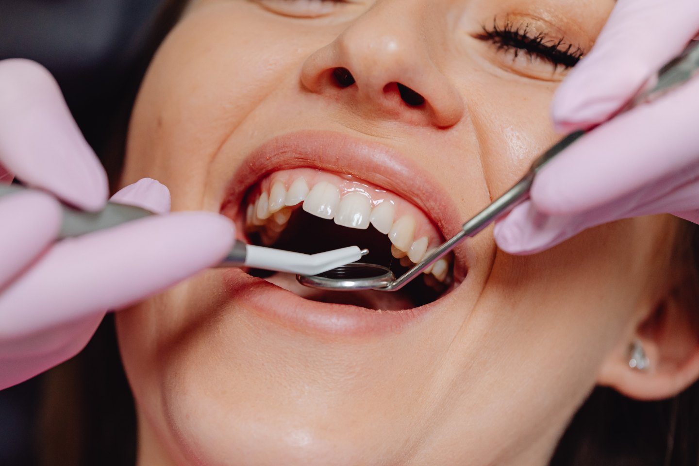 Wobbly Tooth Be Saved