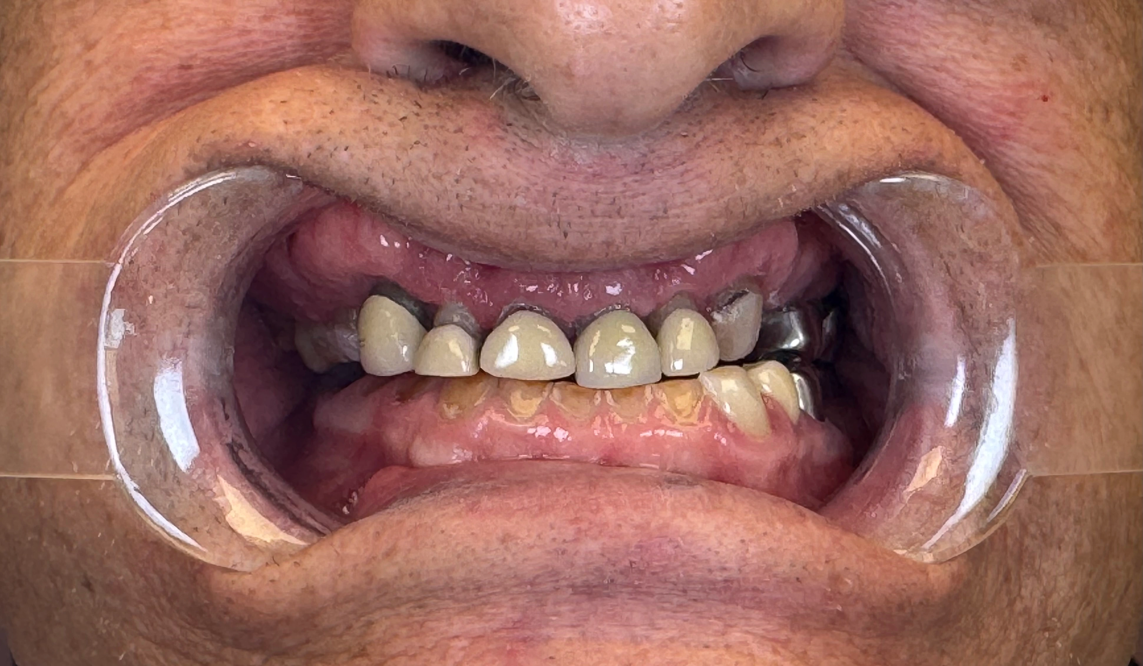 After Full Mouth Rehabilitation