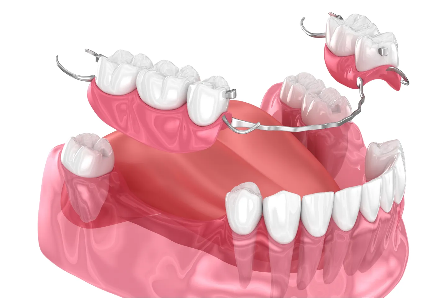 Missing Teeth Treatment Images