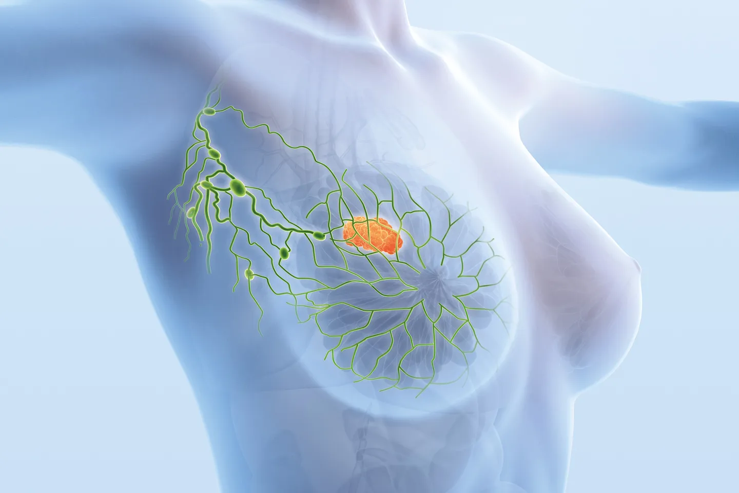 Mastectomy With Sentinal Lymphnode Biopsy
