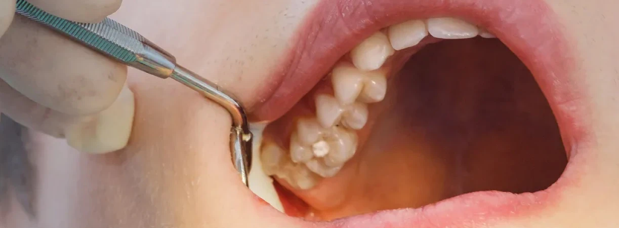 Fillings