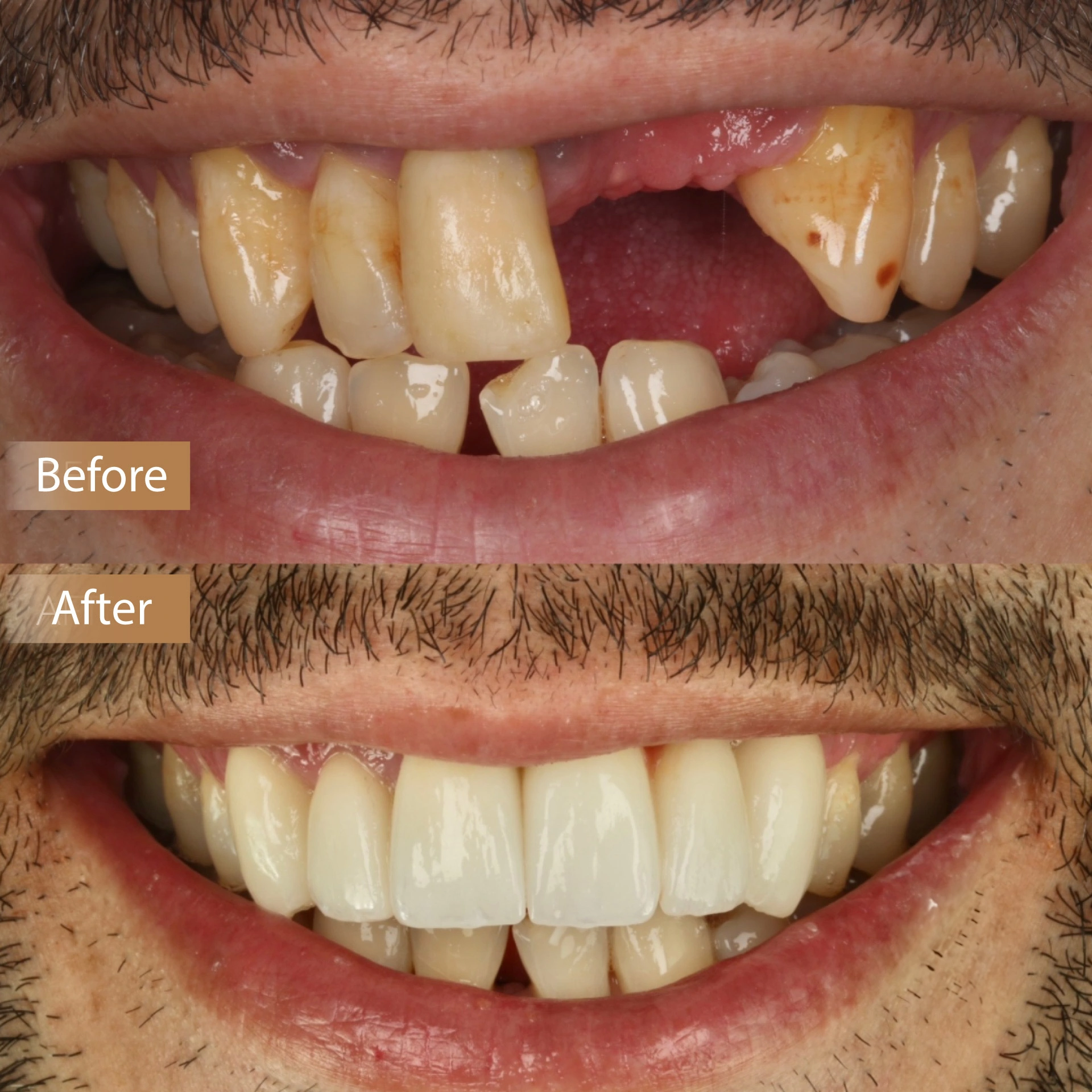 Smile Reconstruction & Implants image