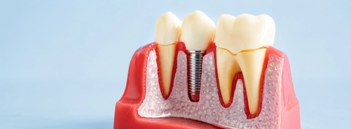 Implant Dentistry
