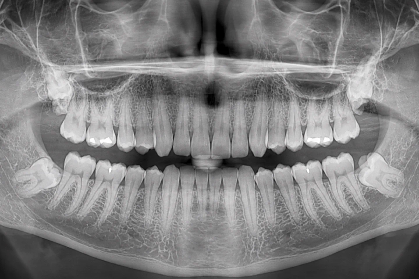 Root Canal Treatment Illustration