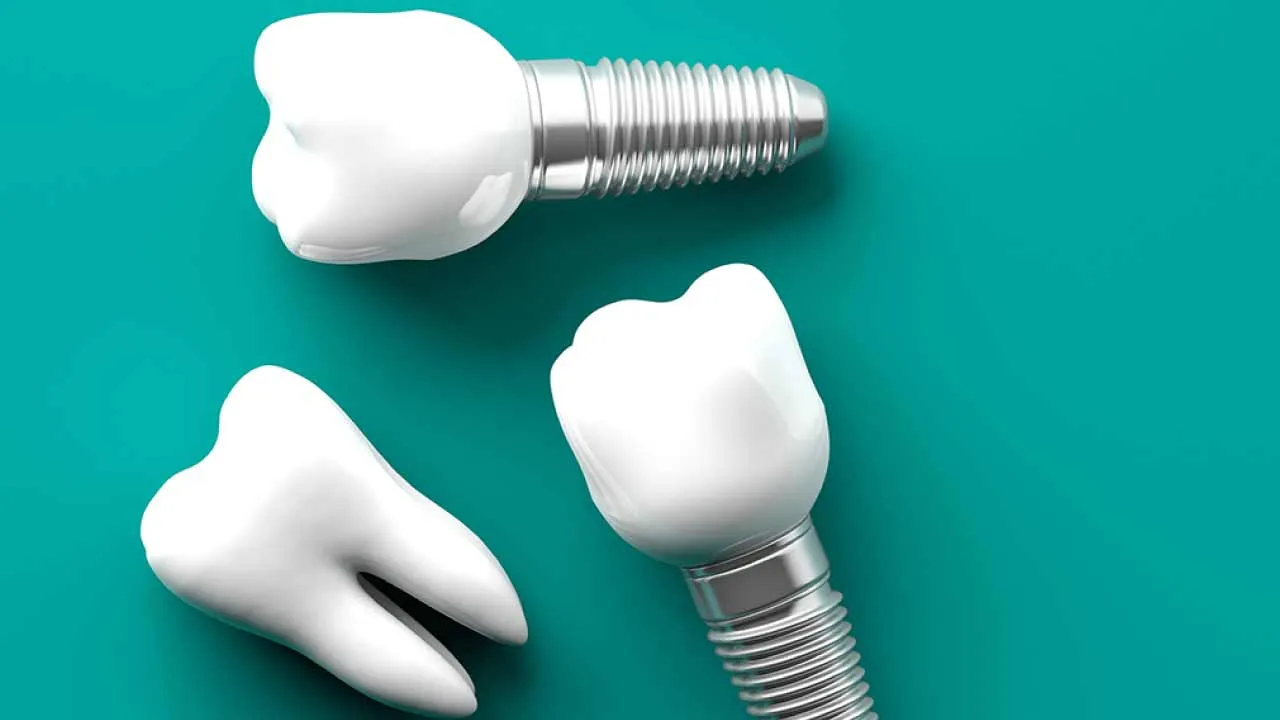 Single & Multiple Tooth Implants | Delight Dental Studio