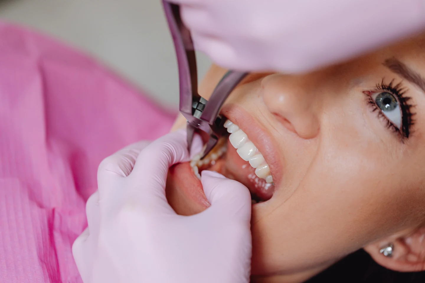 Can You Eat After a Root Canal
