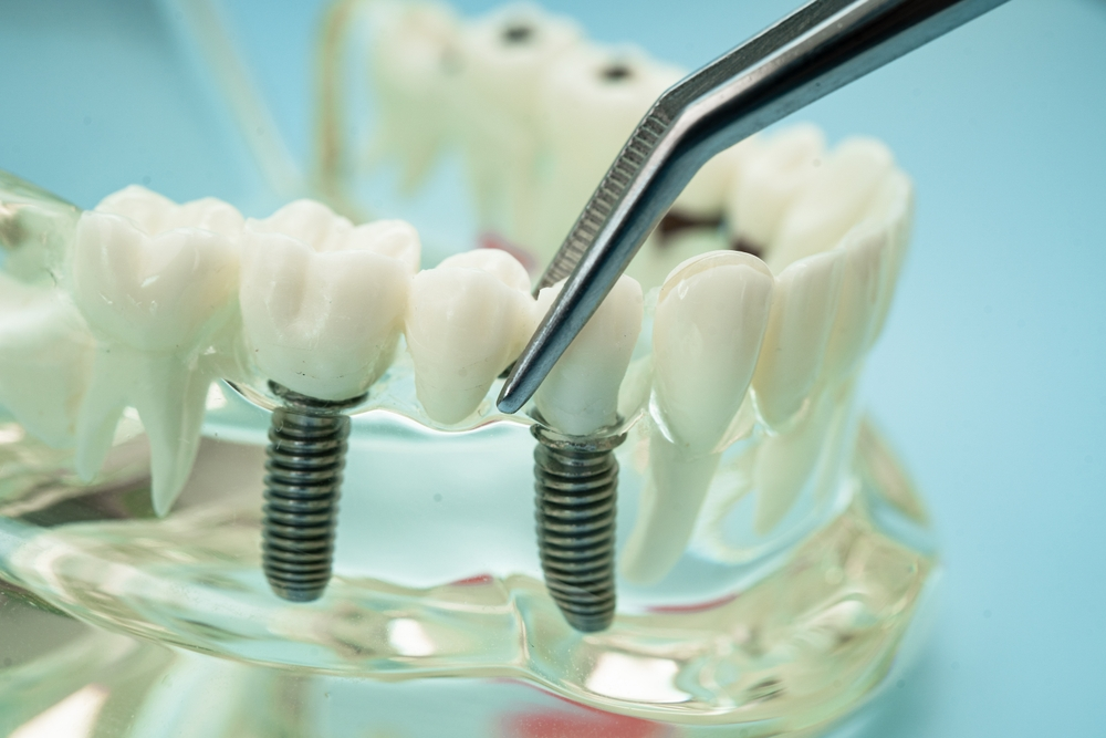 How to Care for Dental Implants | Long-Term Maintenance Tips