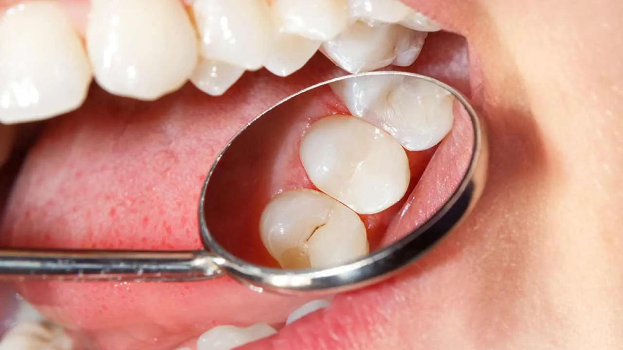 Composite Fillings