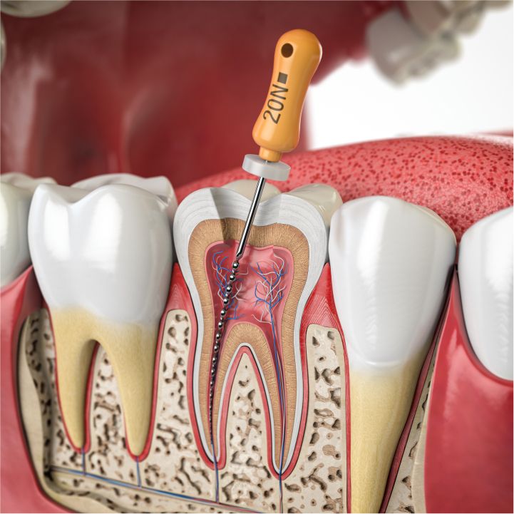 Know the Symptoms & Save Your Tooth
