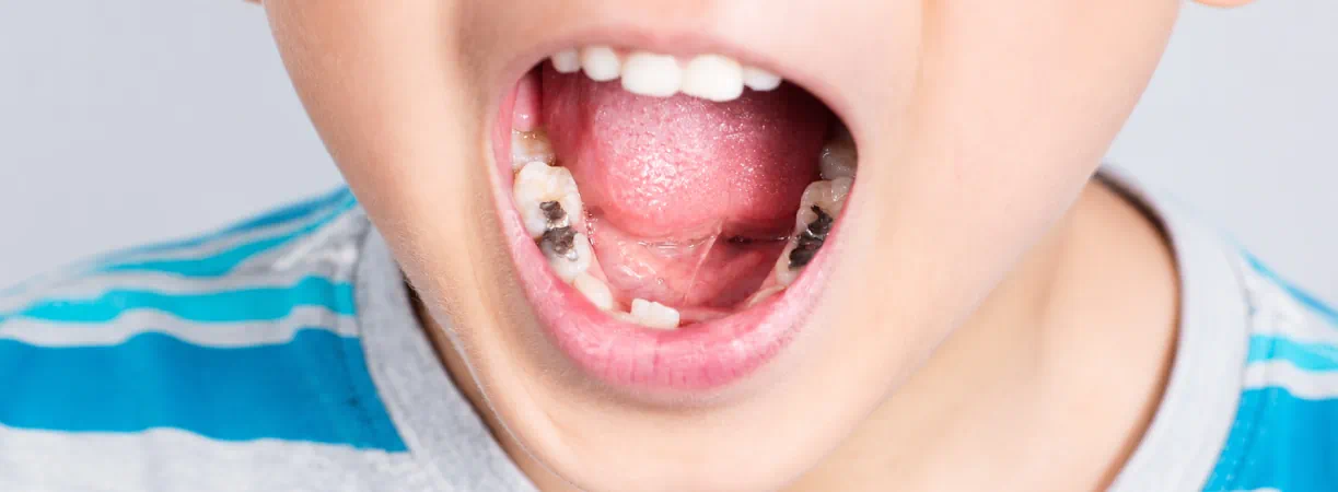 Fillings