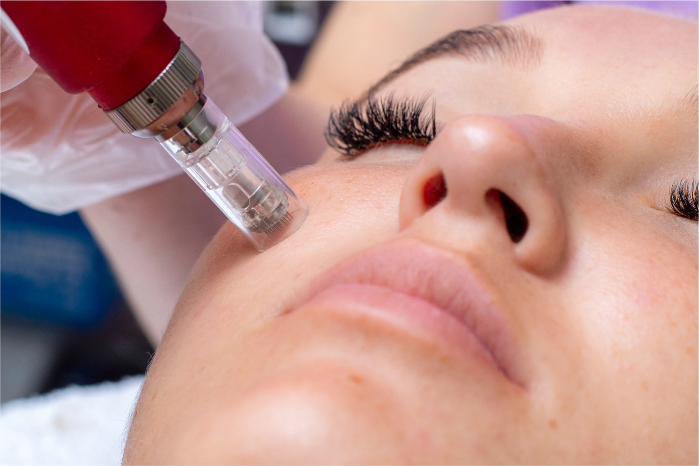Microneedling in Encinitas