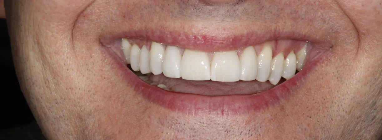 Smile Makeovers