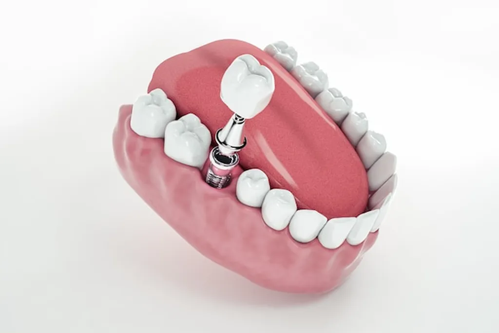 Single Tooth Implant