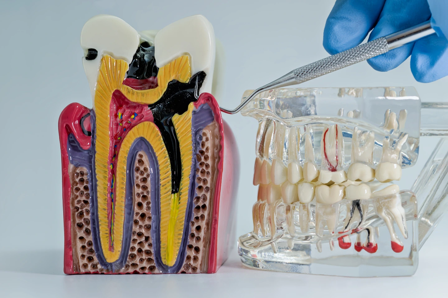 Dental models showing infected and fractured tooth anatomy used to assess need for extraction.
