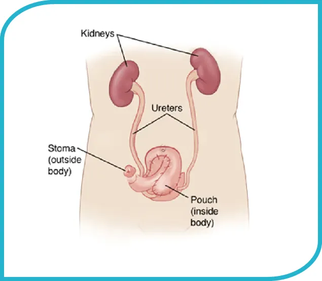 Laparoscopic Radical Cystectomy