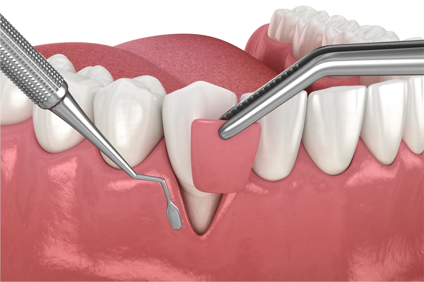 Soft Tissue Grafting